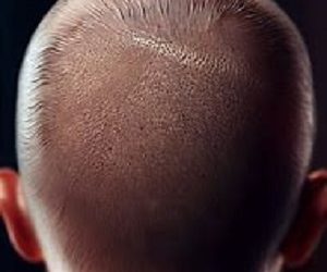 Scalp Micropigmentation: Treatment for Thinning Hair or Hair Loss